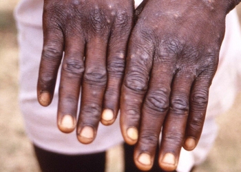 何谓猴痘?又该怎么预防呢?