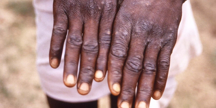 何谓猴痘?又该怎么预防呢?